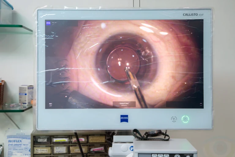 cataract operation on screen
